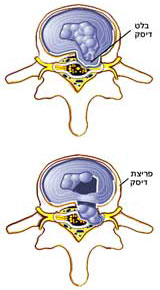 פריצת דיסק, בלט דיסק, אורתופדיה