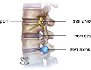 פריצת דיסק, בלט דיסק