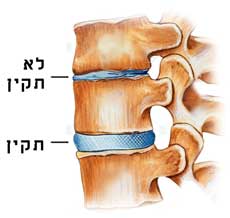 Read more about the article שחרור לחץ בין-חוליתי