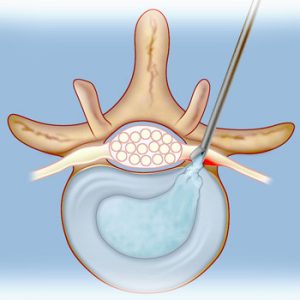 ניתוח דיסקקטומיה